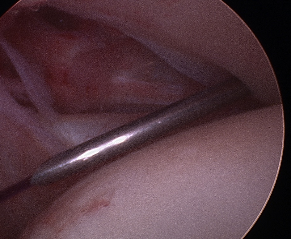 Arthroscopy Tagging Biceps Tendon